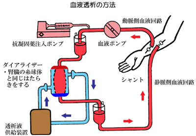 血液透析の方法