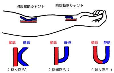 シャントとは